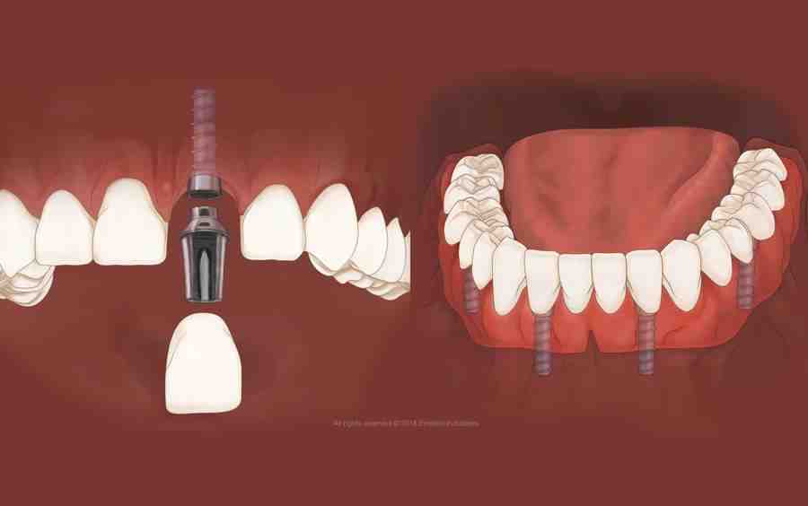 How long does a dental implant procedure take?