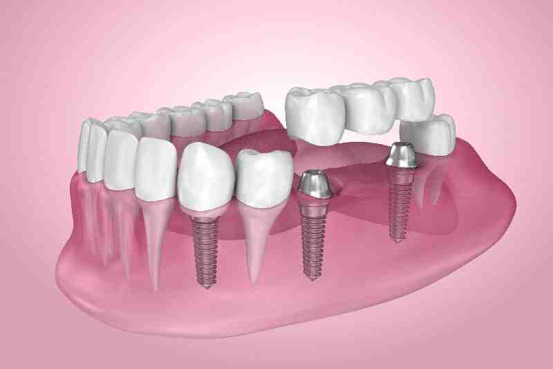 How long does a dental implant procedure take?