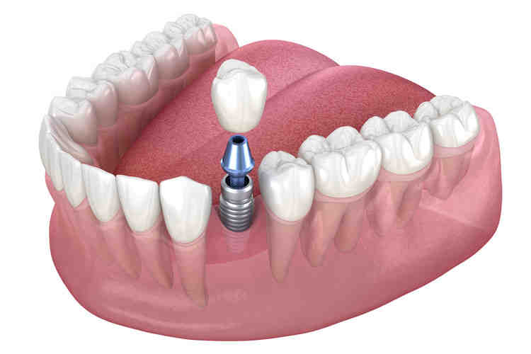 How long does it take for dental implants to settle?