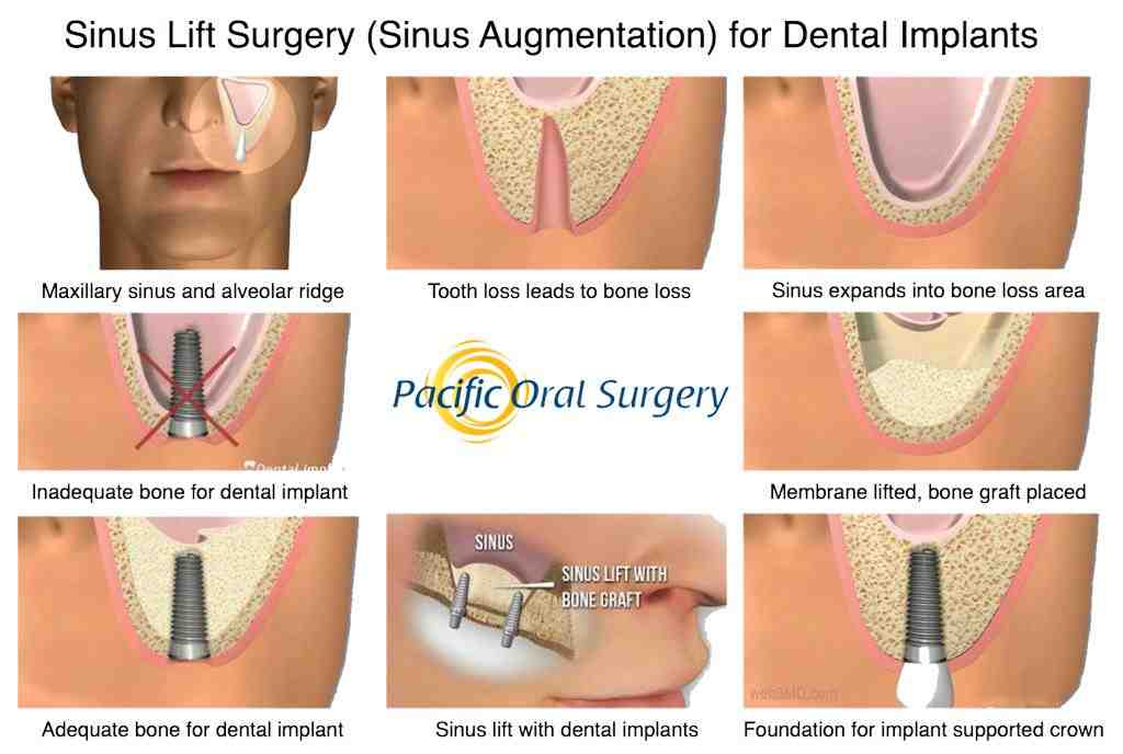 How Long To Lift After Dental Implants Dental News Network