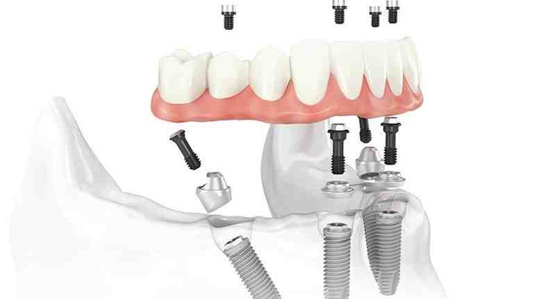 how-long-do-dental-implants-hurt-dental-news-network