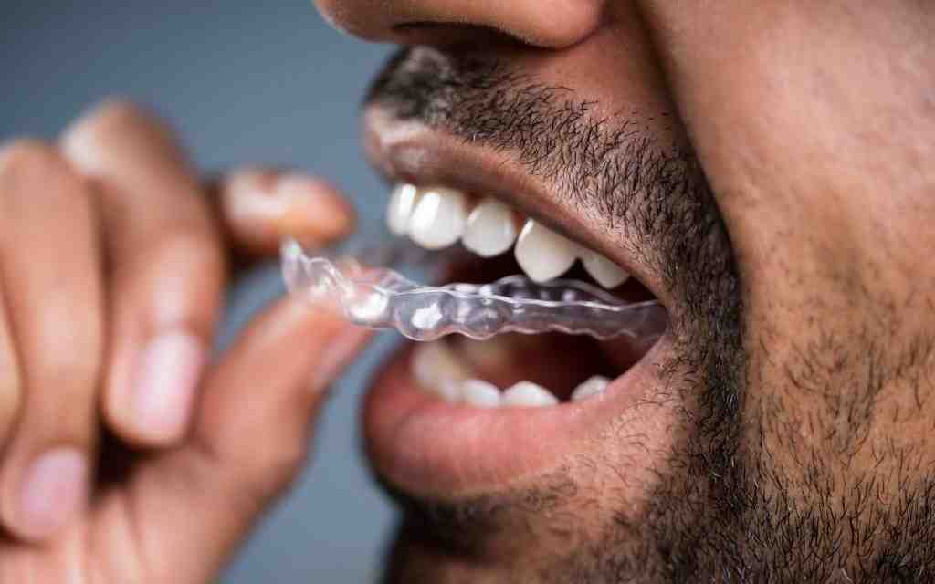 How much are dental implants California 2020?