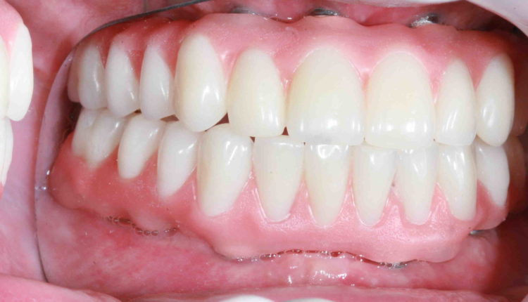 How much are dental implants full mouth