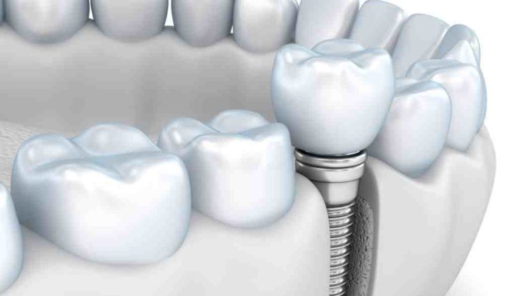 How much are dental implants in texas