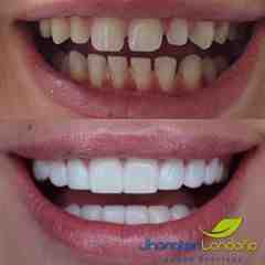 How much are veneers in St Louis Missouri?