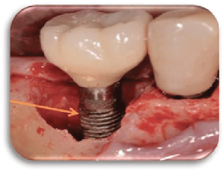 How much bone is required for dental implants?
