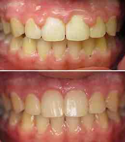 How much do dental implants cost in Italy?