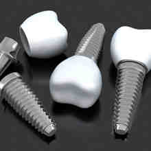 How much do dental implants cost in Virginia?