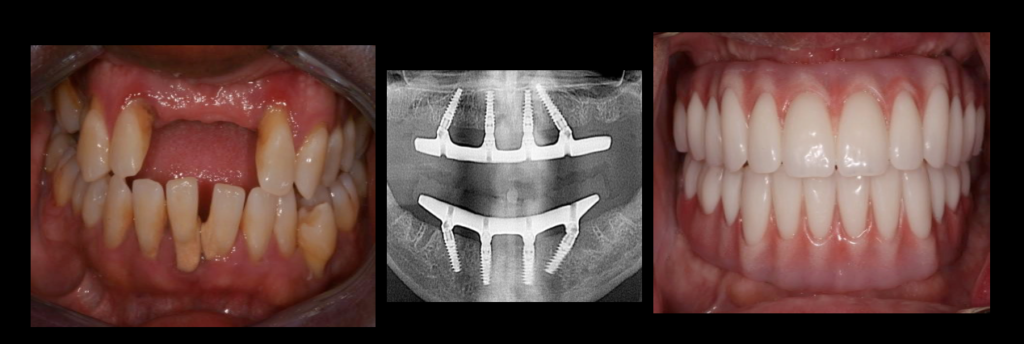 How much do full upper and lower dental implants cost?