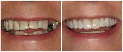 How much do veneers cost in NY?