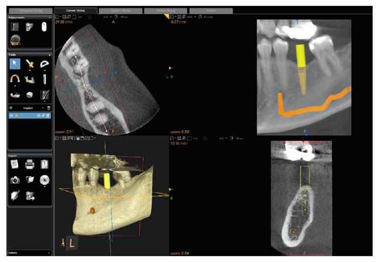 how-to-read-cbct-for-dental-implants-dental-news-network