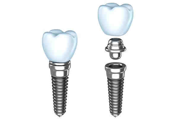 How much does a dental crown cost in Massachusetts?
