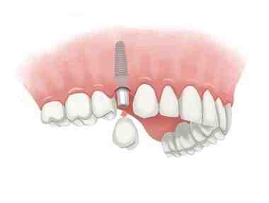 How much does a dental implant cost for one tooth?