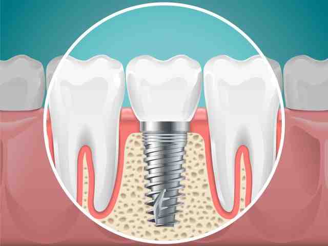 How much does a dental implant cost for one tooth?