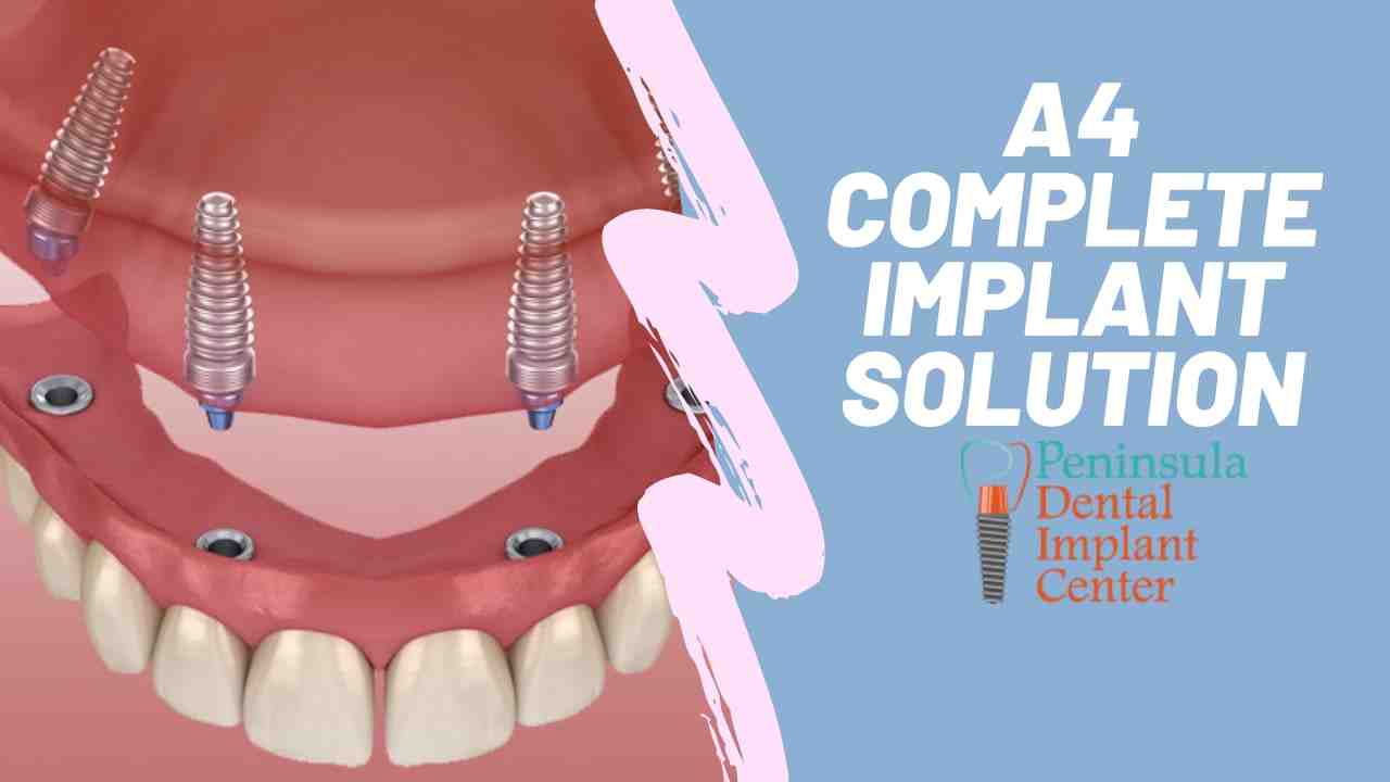 How much does a dental implant cost for one tooth?