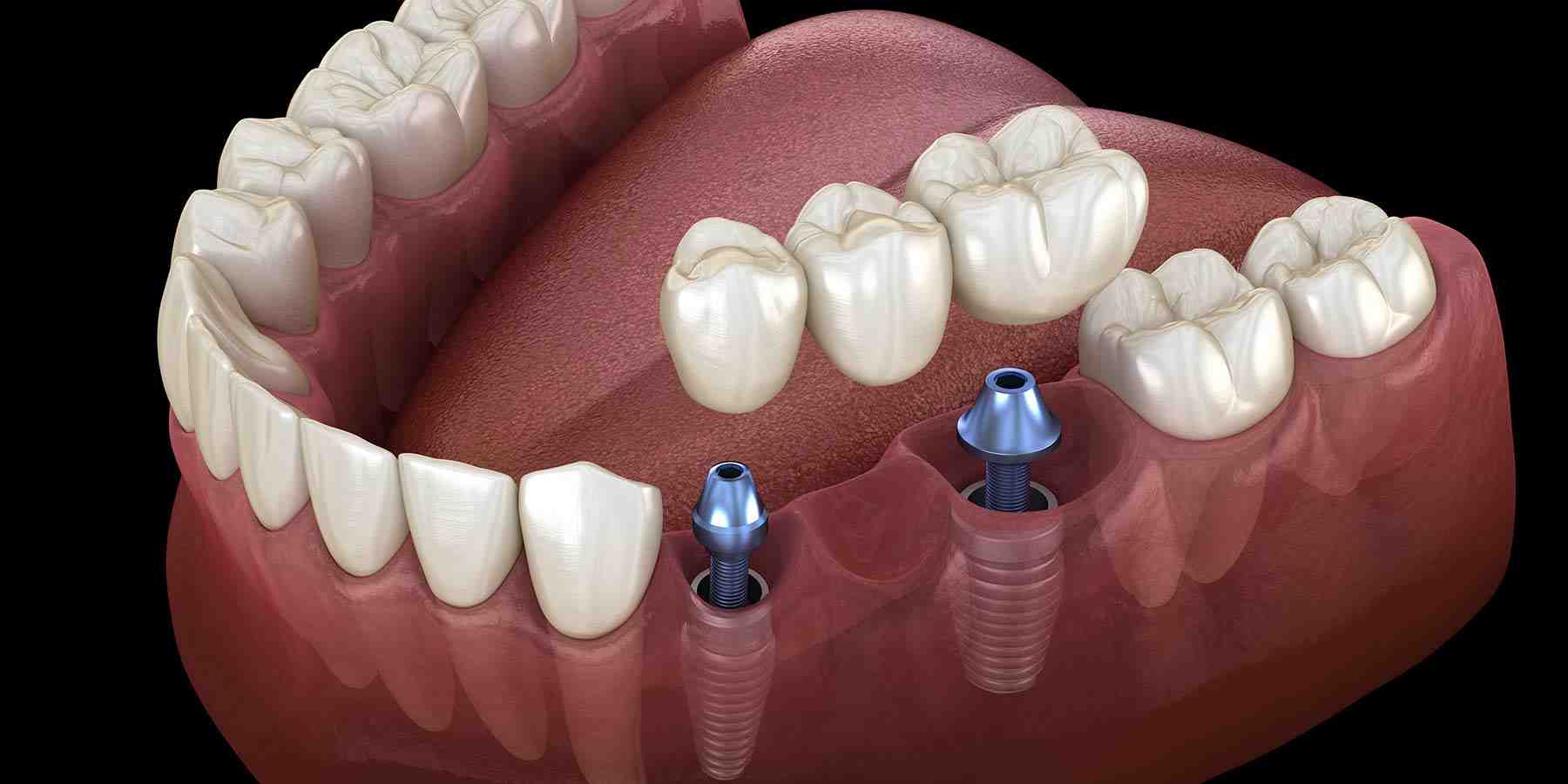 How much does a dental implant cost for one tooth?