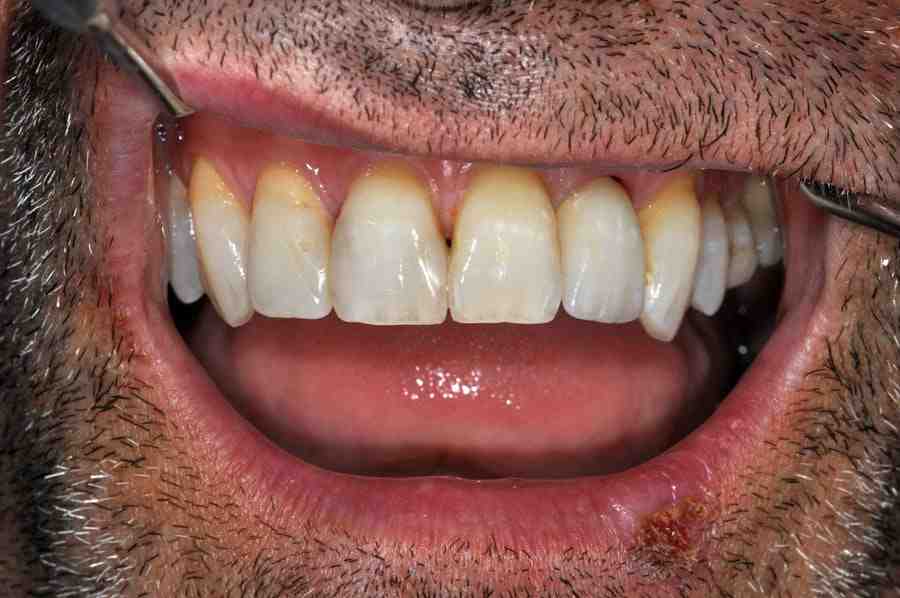 How much does a dental implant cost for one tooth?