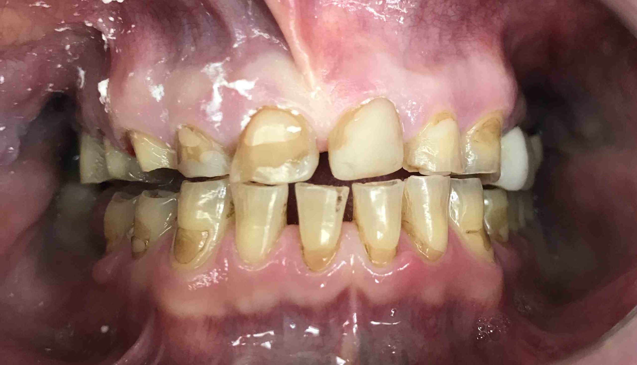 How much does a smile makeover cost UK?
