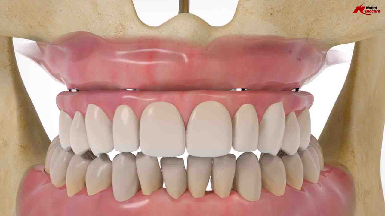 How much does it cost to get teeth done in Thailand?