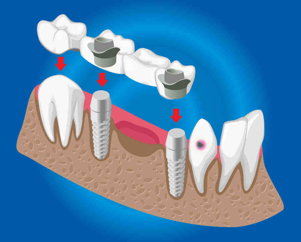 How much does it cost to get your teeth done in Mexico?
