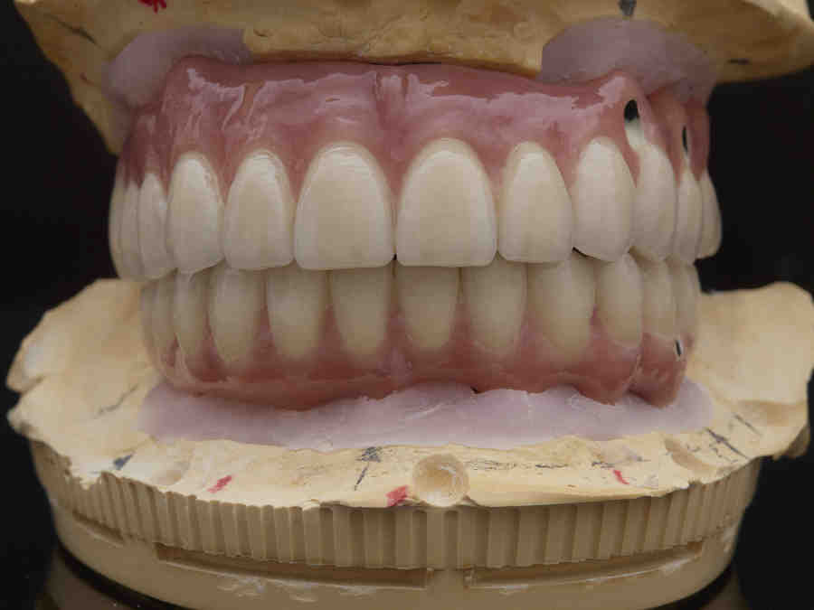 How much are dental implants full mouth Dental News Network