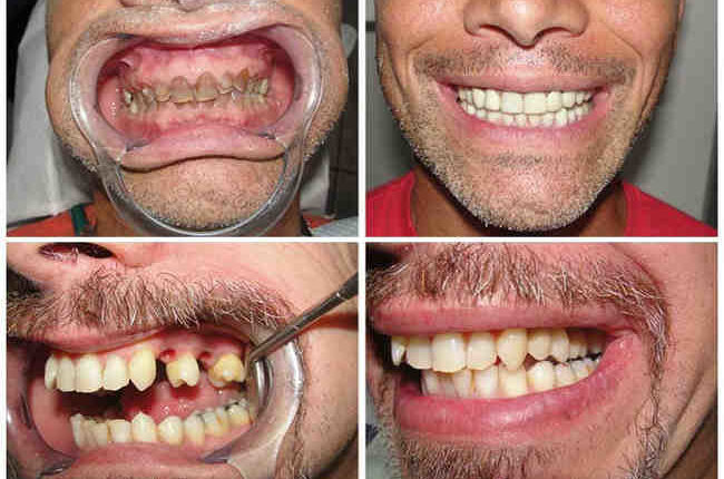 How much for dental implants in mexico