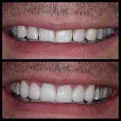 How much is a cosmetic filling?