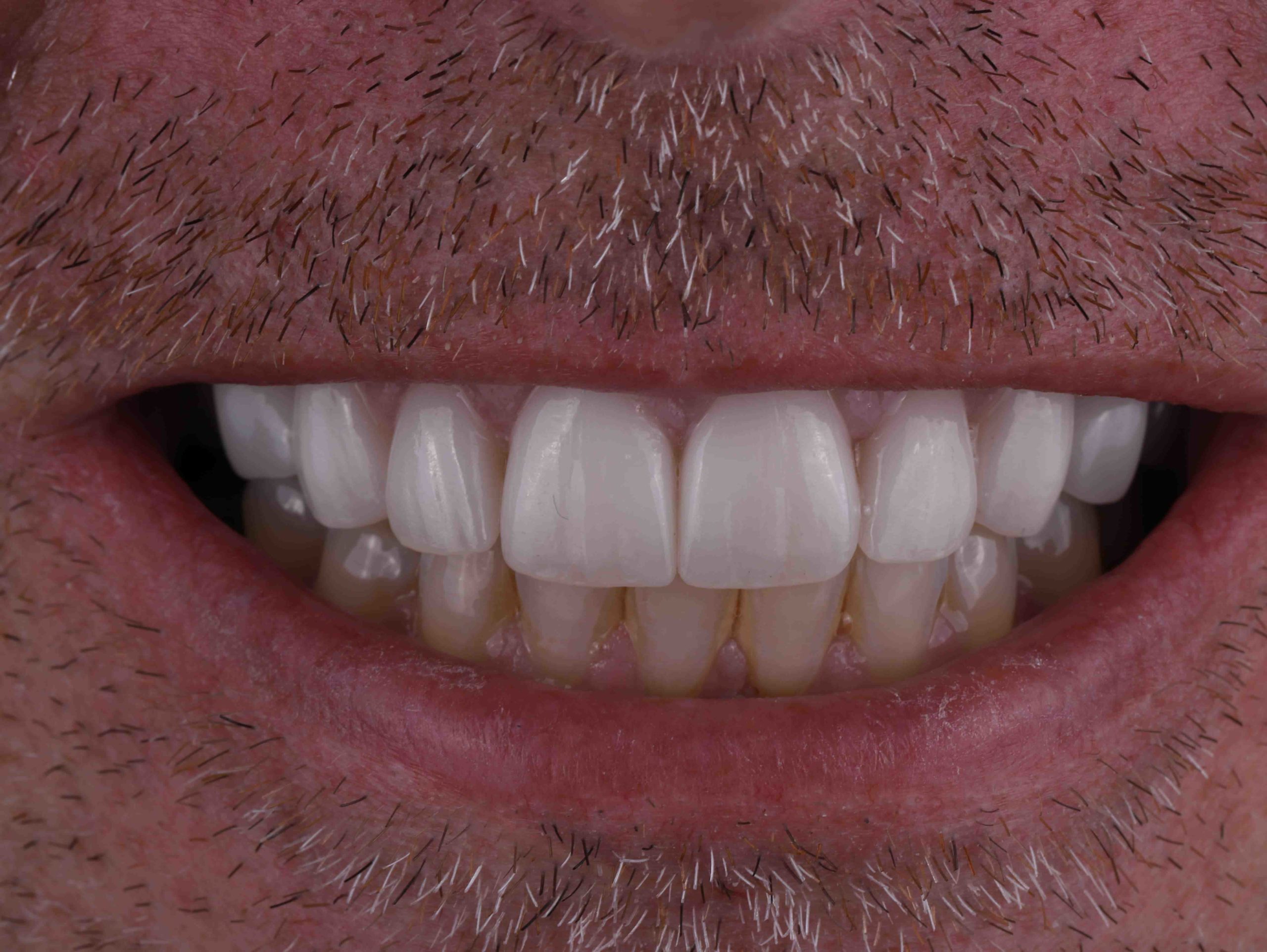 How much is a cosmetic filling?