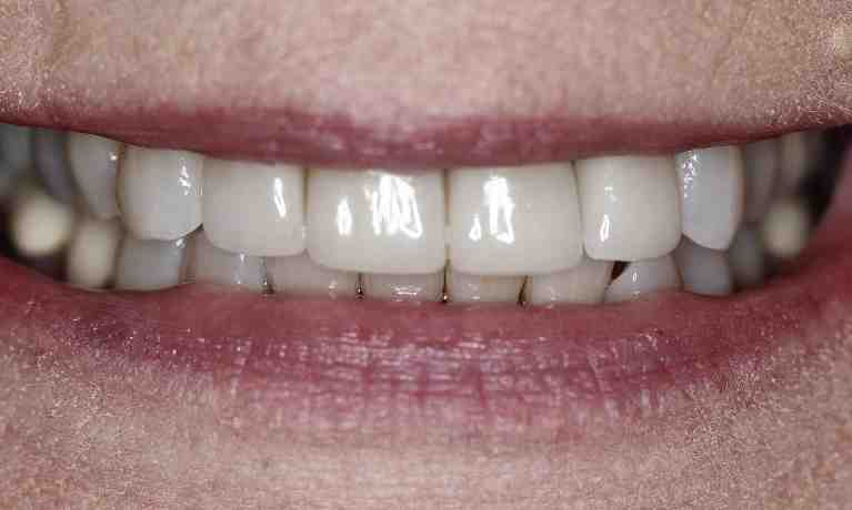 How much is a cosmetic filling?