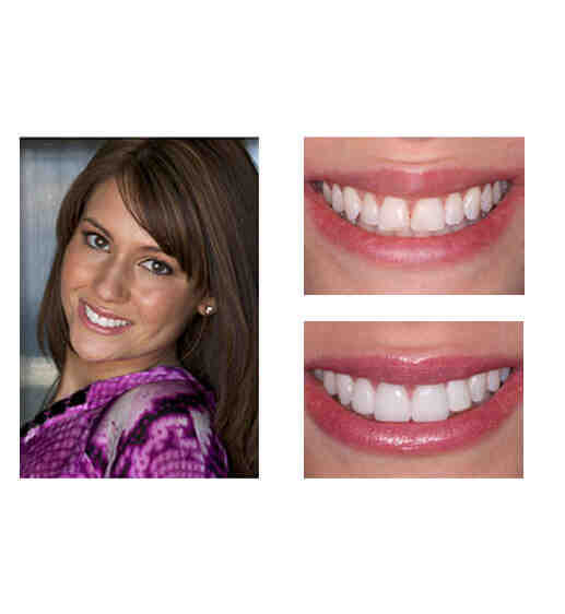 How much is a dental implant for one tooth?