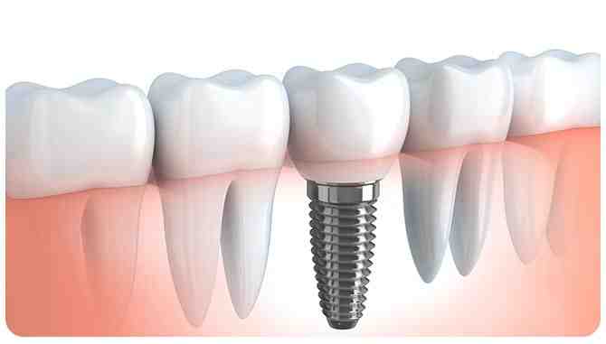 How much is a full set of dental implants?