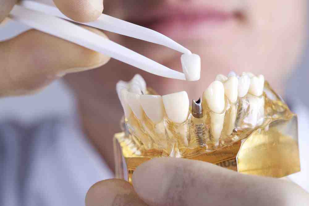 How much is a full set of dental implants?