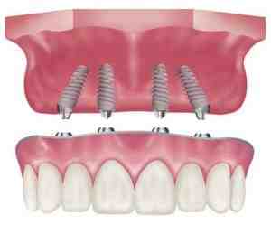 How much is a full top set of dental implants?