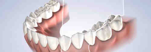 How much is a full top set of dental implants?