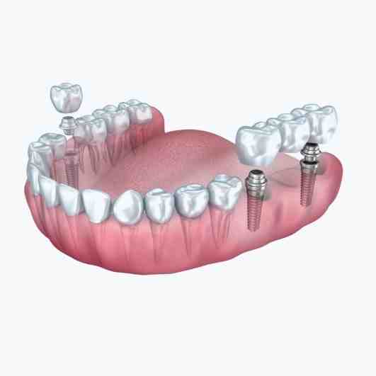 How much is a full top set of dental implants?