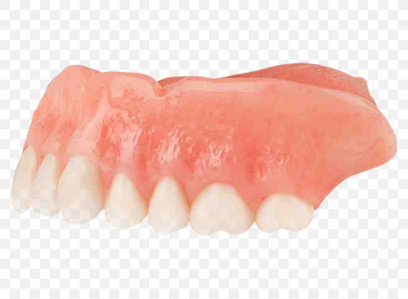 How much is a full top set of dental implants?