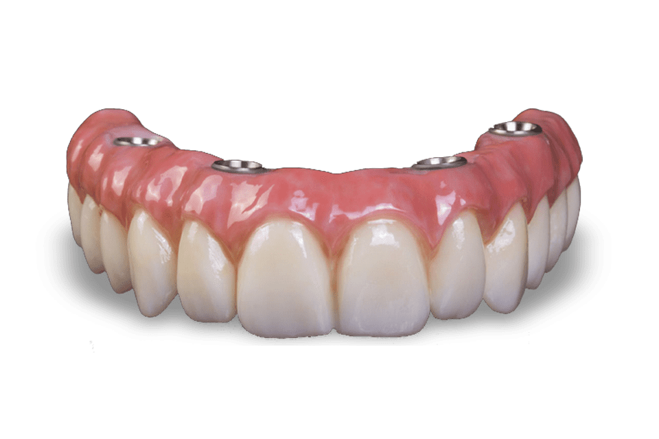 How much is a full top set of dental implants?