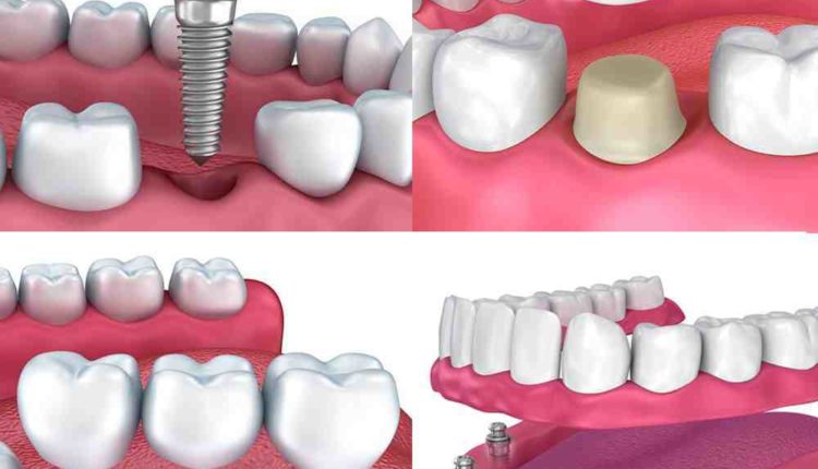 How much is full mouth dental implants