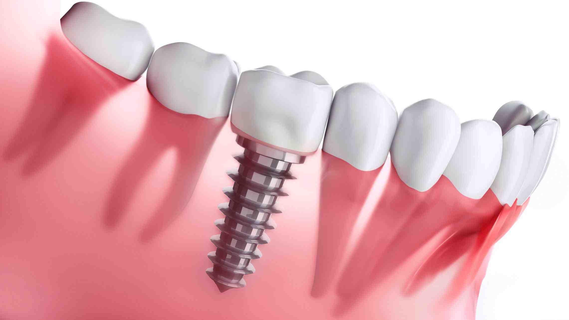 How much should dental implants cost in 2020?