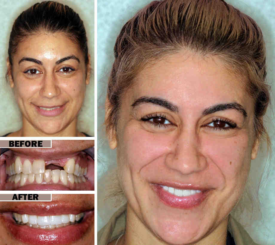 How much should dental implants cost in 2020?