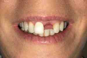 How much should dental implants cost in 2020?