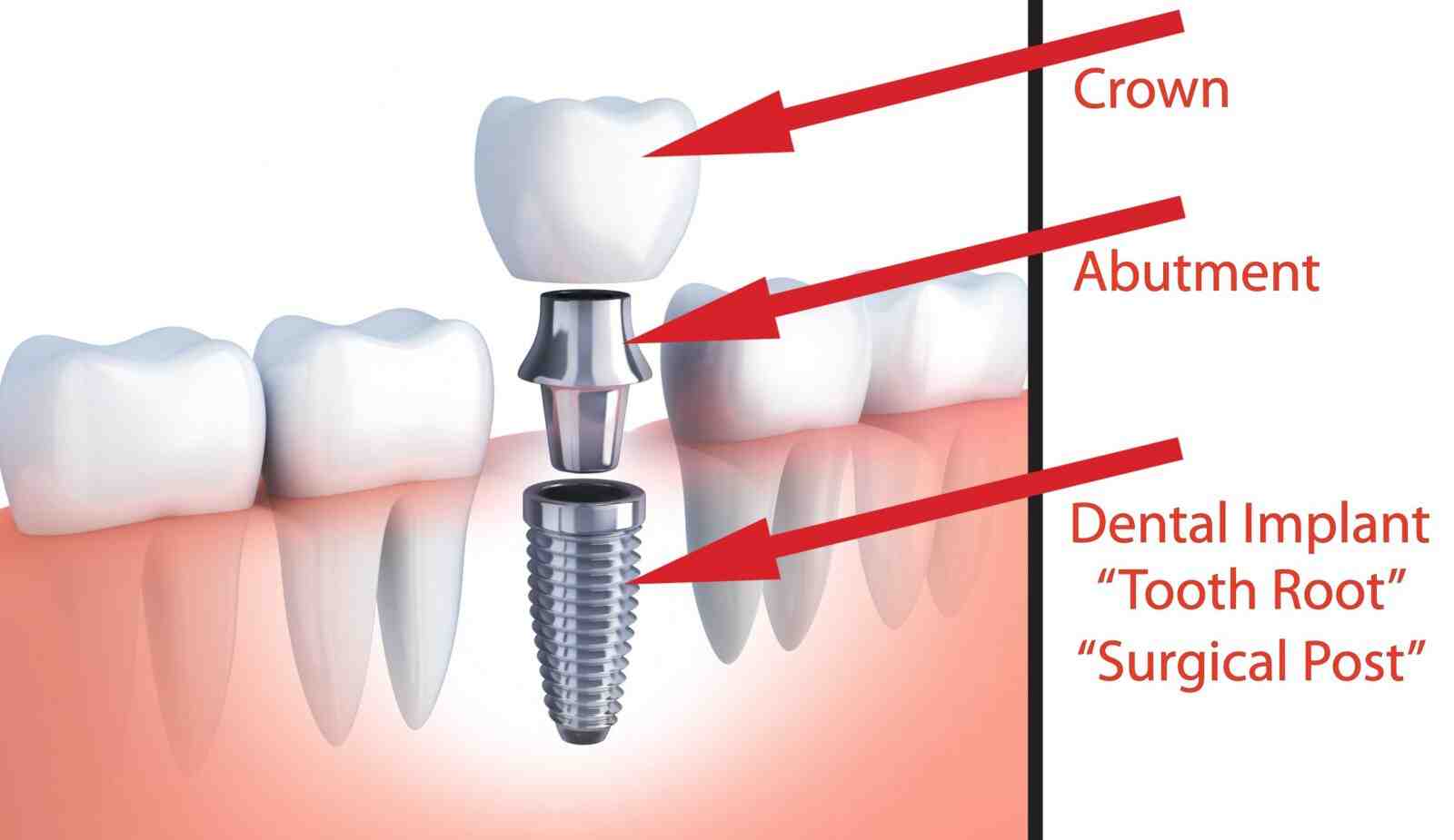 How much should dental implants cost in 2020?