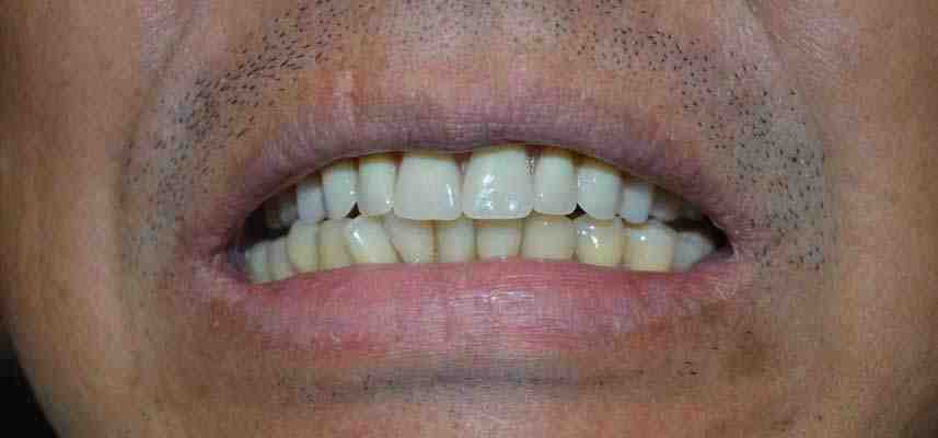 How much should dental implants cost in 2020?