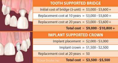 How much will dental implants cost in 2020?