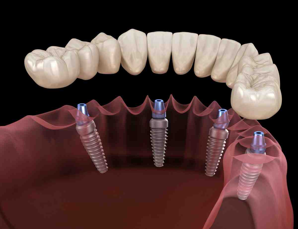 How much will dental implants cost in 2020?