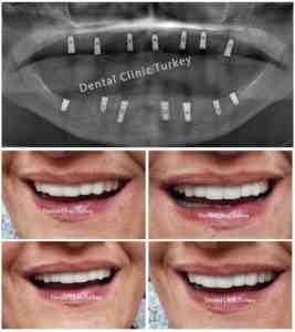 How much will dental implants cost in 2020?