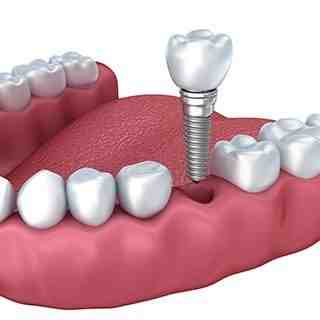 Can dental implant fall out? - Dental News Network