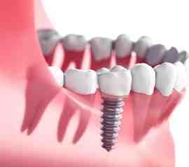 How painful is a tooth implant?