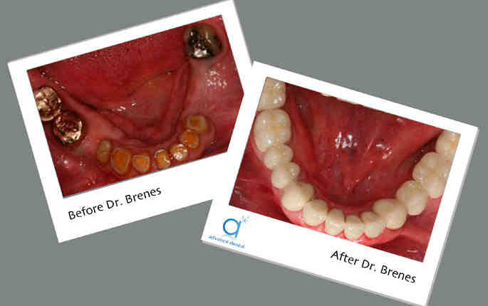 How to clean fixed dental implants