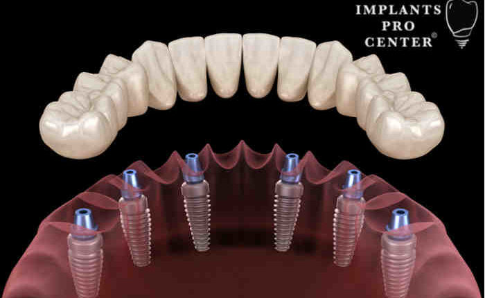 does sun life insurance cover dental implants
